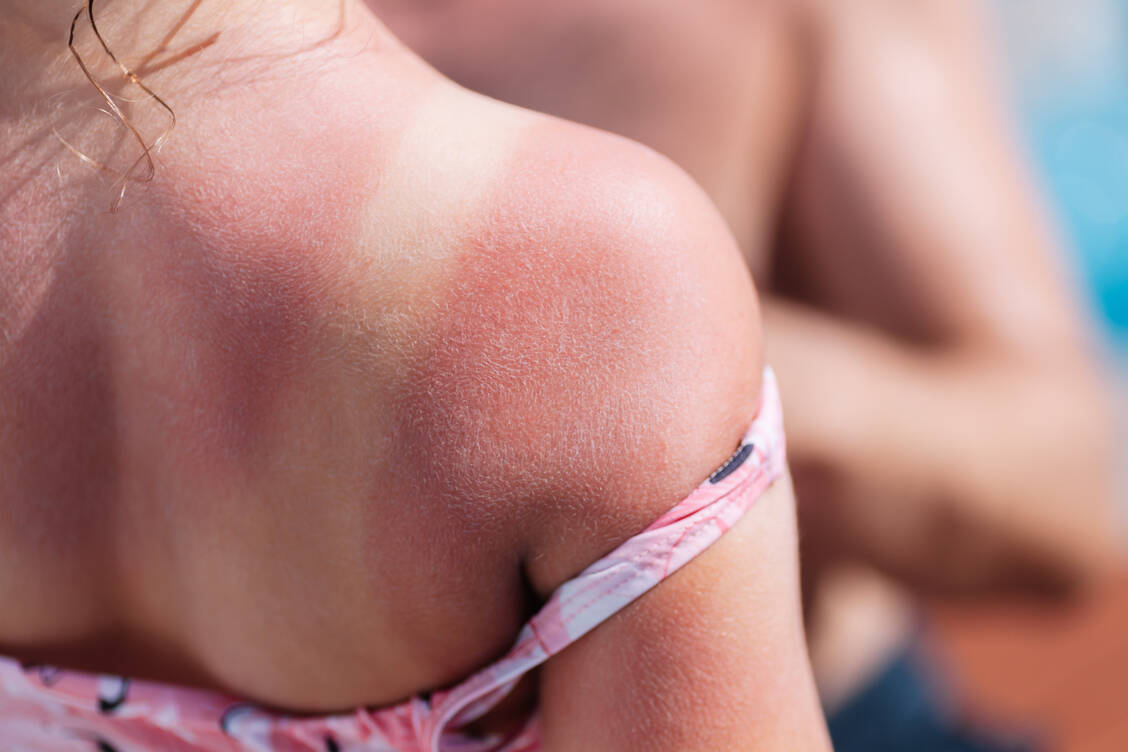 »Die Haut vergisst nicht. Auch wenn sie sich von einem Sonnenbrand dem Anschein nach erholt – Schaden nimmt sie trotzdem«, betont die Leiterin des DKFZ-Krebsinformationsdienstes, Susanne Weg-Remers. / © Getty Images/Iuliia Burmistrova