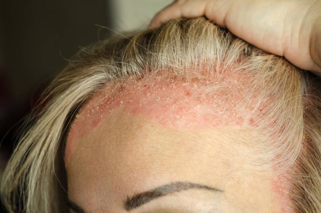 Psoriasis-Patienten leiden besonders, wenn sichtbare Hautpartien betroffen sind. / Foto: Adobe Stock/Егор Кулинич