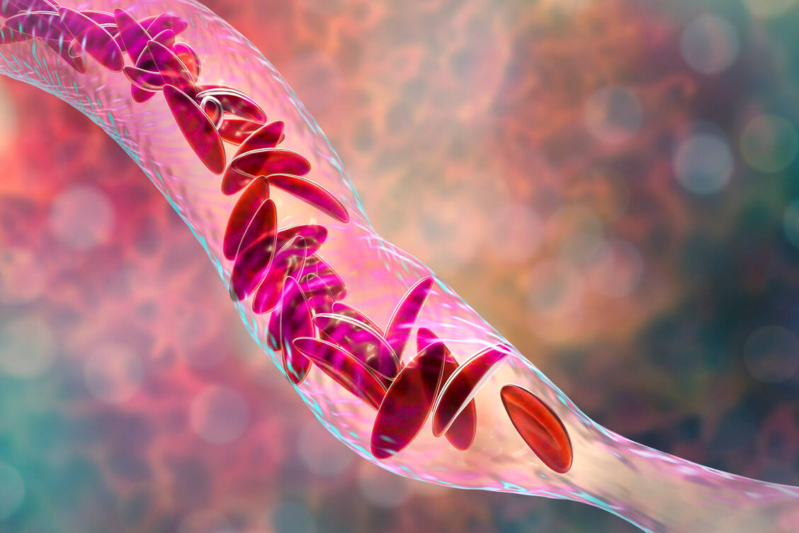 Bei der Sichelzellanämie liegt ein Fehler in den Genen vor – die Erythrozyten weisen dann die typische Sichelform auf. Mithilfe der Genschere CRISPR-Cas9 kann der Genfehler korrigiert werden.  / © Adobe Stock/Kateryna_Kon