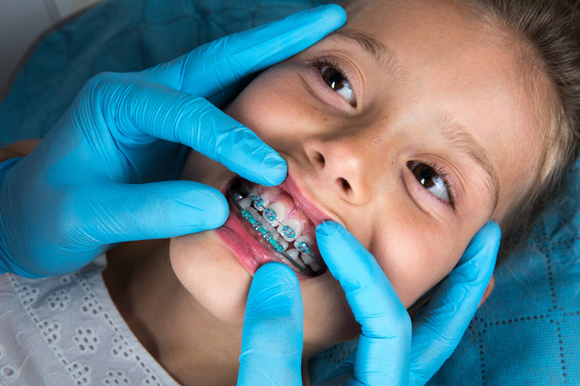 Kinder entscheiden sich bei festsitzenden Zahnspangen gerne für farbige Brackets. Erwachsene bevorzugen unauffälligere Varianten. / Foto: Adobe Stock/Valeriya Zankovych