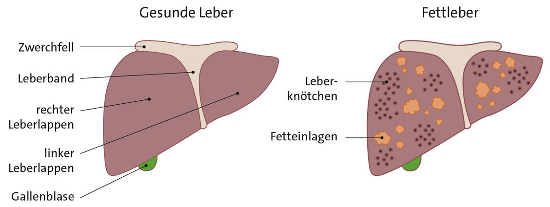 Es dauert lange, bis sich Symptome zeigen, weil die Leber zunehmend verfettet.  / Foto: PTA-Forum