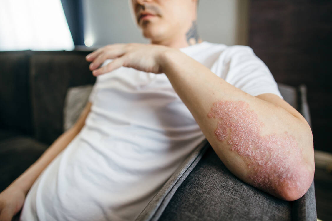 Rötlich-weiße Plaques auf der Haut sind das bekannteste Erscheinungsbild der Psoriasis. / © Getty Images/Tanja Ivanova
