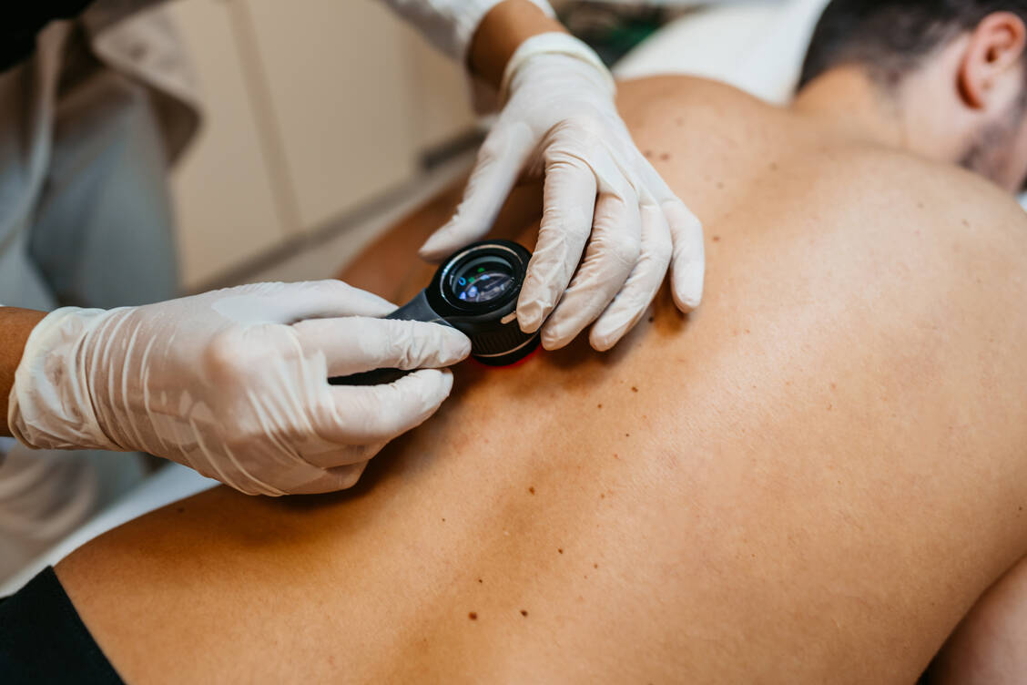 Veränderungen bei Leberflecken sollte man beobachten und gegebenenfalls bei der Dermatologin abklären lassen.  / © Getty Images/urbazon
