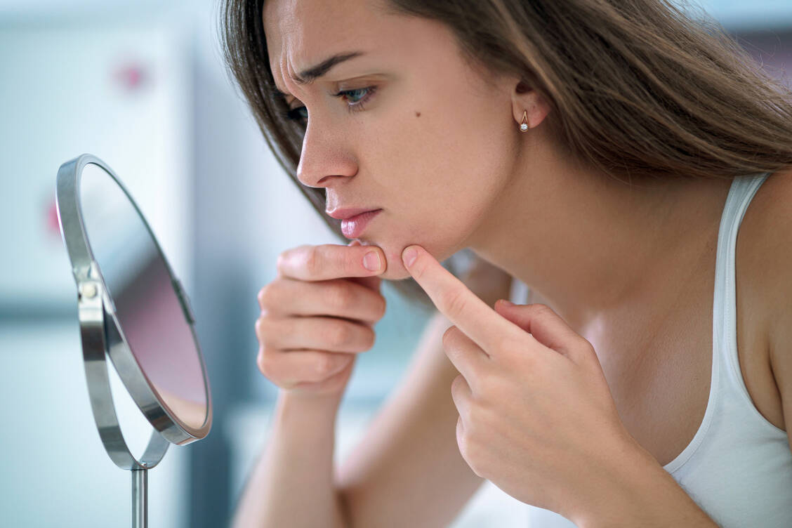 Die heutige Akne-Therapie ist zwar nach wie vor eine Geduldsprobe, aber angenehmer durchzuhalten als noch vor zehn Jahren. / Foto: Adobe Stock/Goffkein