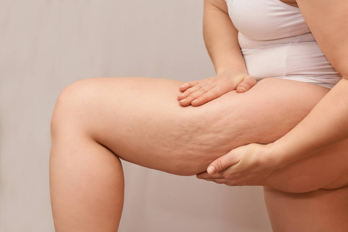Cellulite ist völlig normal, doch viele Frauen wünschen sich straffere Haut an Po und Oberschenkeln. Was hilft gegen die Dellen? / © Getty Images/Elena Safonova
