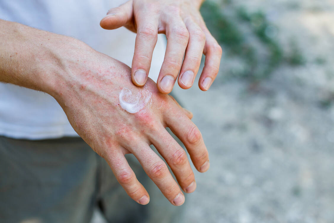 Die Anwendung von Glucocorticoiden auf der Haut ist  normalerweise auf zehn Tage begrenzt, da Nebenwirkungenin der Regel erst zwei Wochen nach Beginn der Therapie auftreten. / Foto: Adobe Stock/Olga Ternavskaya
