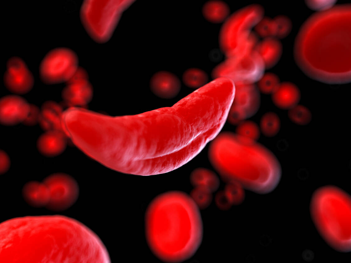 Die Sichelzellanämie ist eine Erbkrankheit, bei der sich die roten Blutzellen sichelförmig verformen.  / Foto: Adobe Stock/SciePro