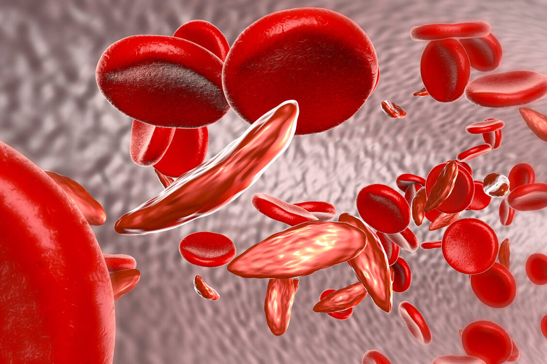 Die Sichelzellanämie wird autosomal rezessiv vererbt und durch eine Mutation im Gen HBB (Hämoglobin ß) auf Chromosom 11p15.5 verursacht. / Foto: Shutterstock/Kateryna Kon