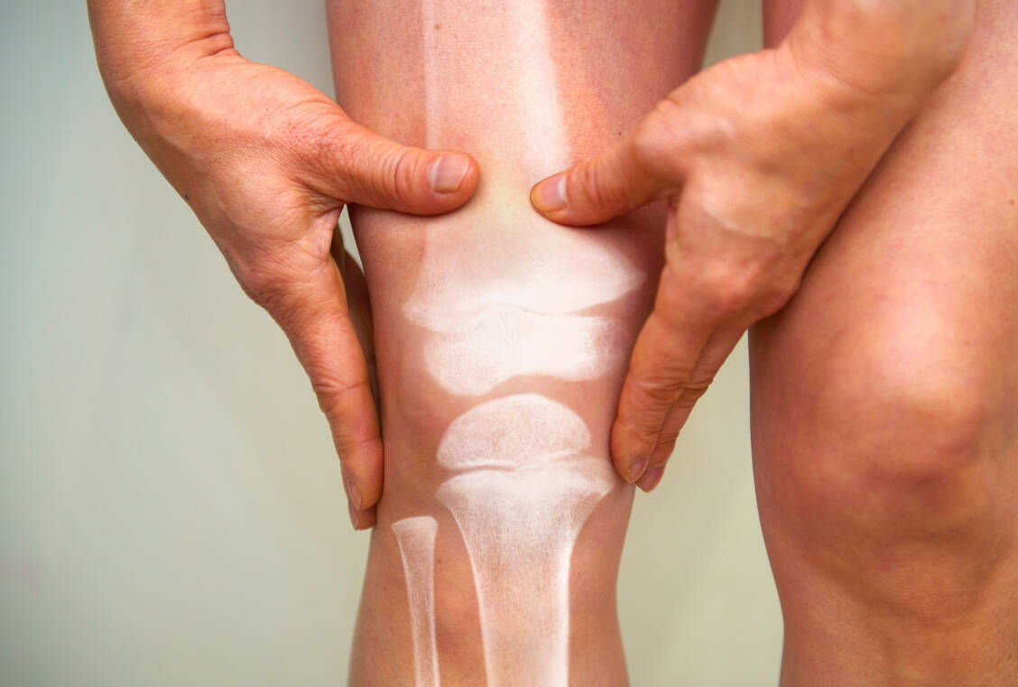 Begleiterkrankungen wie rheumatoide Arthritis können ein Risikofaktor für Osteoporose sein. / Foto: Getty Images/Peter Dazeley