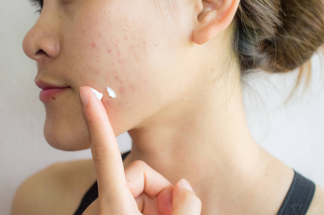Trifaroten zeigt komedolytische Aktivität und besitzt antientzündliche Effekte. Beides mildert Akne. / Foto: Adobe Stock/boyloso