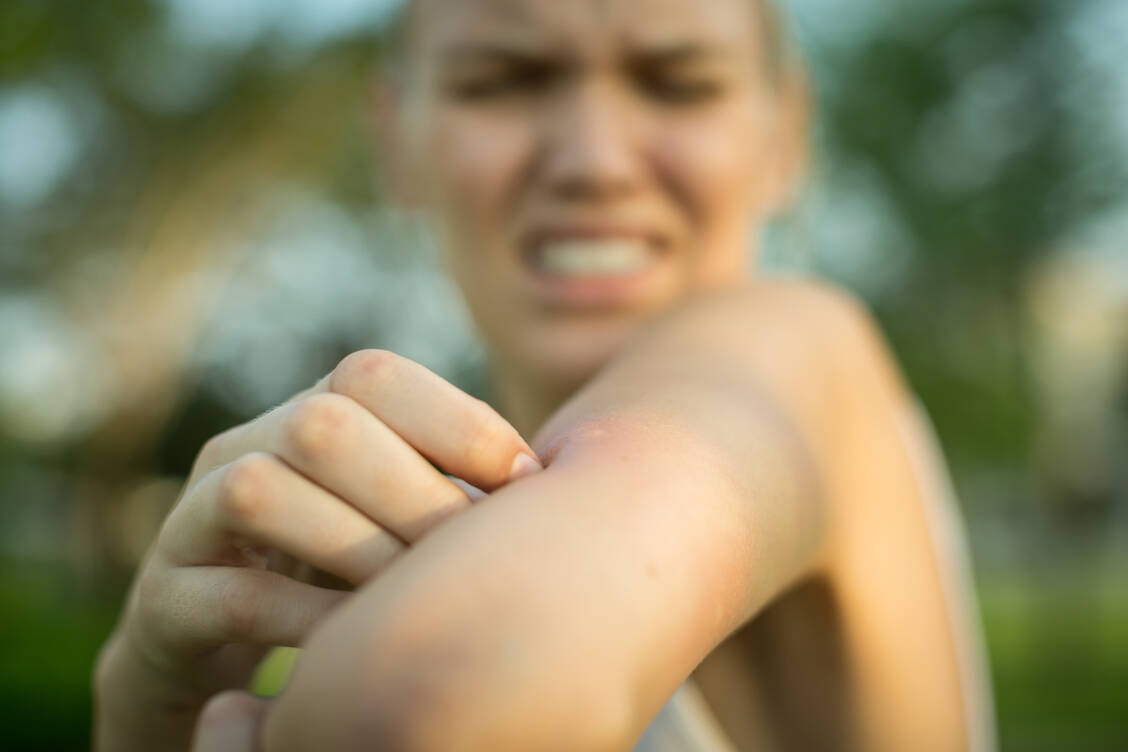Eine normale lokale Schwellung nach einem Insektenstich kann mehrere Zentimeter groß werden. Sogenannte überschießende Lokalreaktionen werden über 10 cm groß und können bis zu 24 Stunden anhalten. Kommen noch weitere Beschwerden wie Atemnot oder Schwellungen und Juckreiz an anderen Körperstellen hinzu, deutet das auf eine allergische Reaktion hin, die ärztlich abgeklärt werden sollte. / © Getty Images/globalmoments