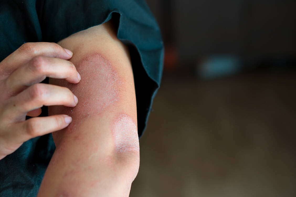 Patienten mit Schuppenflechte leiden unter schuppigen, juckenden Plaques, die sich am Körper ausbreiten können.  / Foto: Shutterstock/sattahipbeach