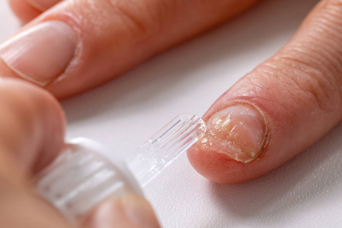 Onychomykosen können die Nagelplatte zerstören. Mit einem Lack und viel Geduld sind sie aber gut heilbar. / Foto: Adobe Stock/ronstik