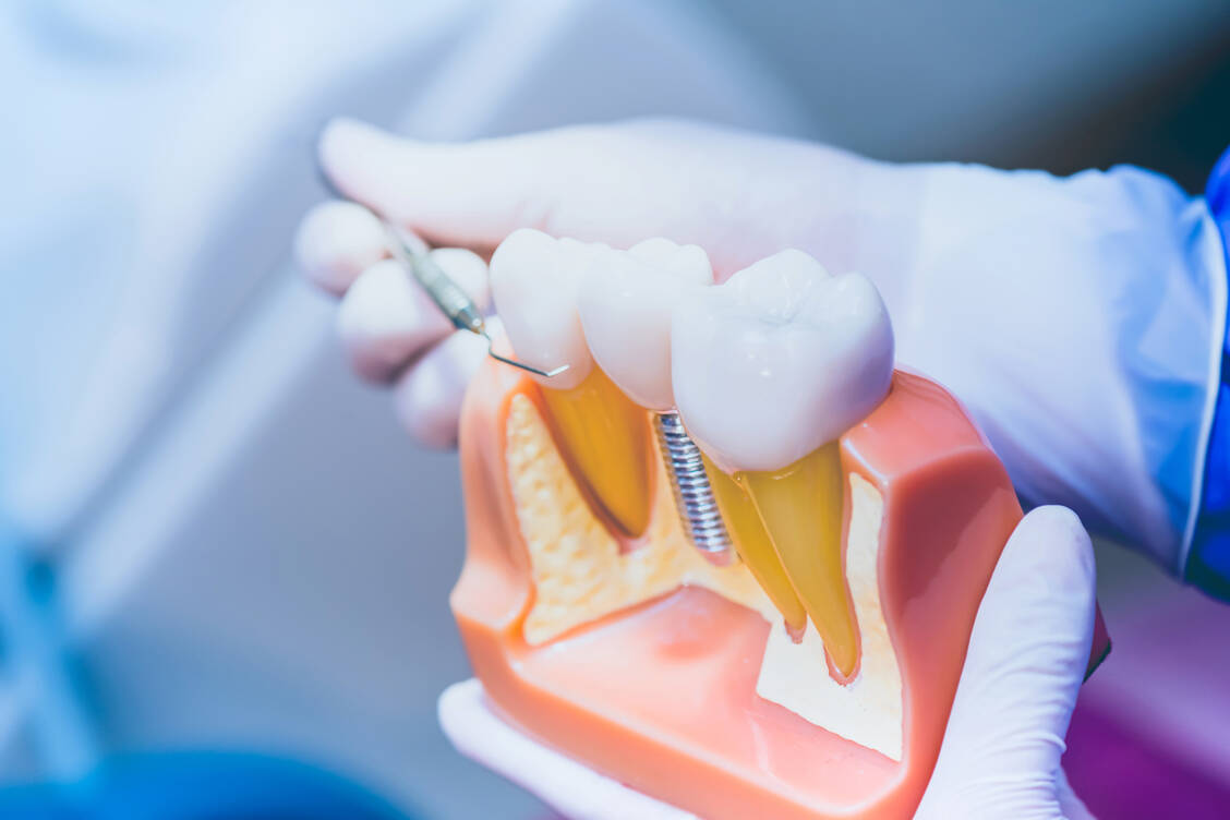 Implantate sind heute eine häufige Lösung für Zahnersatz. Sie einzusetzen, sollte man aber einem Spezialisten überlassen. / Foto: Adobe Stock/graphixchon