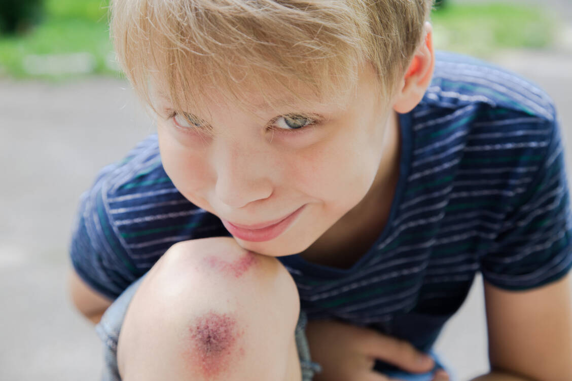 Vor allem Kinder kommen nicht selten mit Schürfwunden und kleinen blutenden Stellen nach Hause. Was dann zu tun ist. / Foto: Adobe Stock/Andrii Oleksiienko