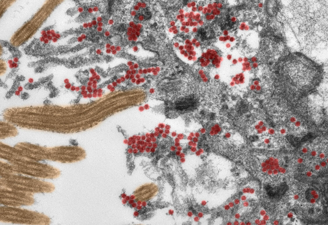 Wissenschaftlern der Charité und der Universität Göttingen gelangen die ersten elektronenmikroskopischen Aufnahmen intakter Coronaviruspartikel in der Riechschleimhaut. / Foto: Michael Laue/RKI & Carsten Dittmayer/Charité