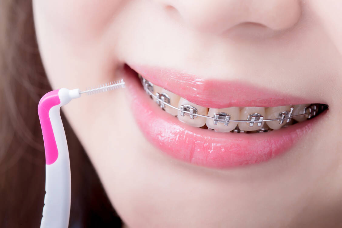 Interdentalbürstchen unterstützen die Mundhygiene, vor allem bei festsitzenden Zahnspangen. / Foto: Getty Images / RyanKing999