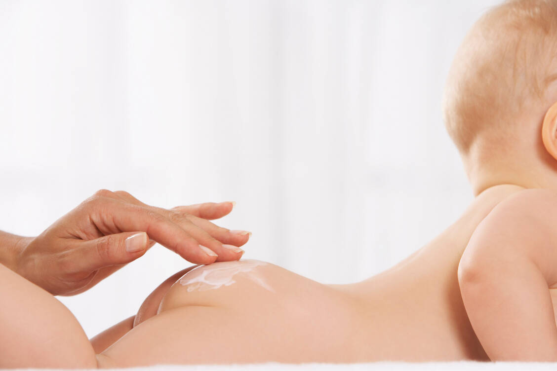 Bei der Windeldermatitis ist die Haut stark entzündet und kann wunde Stellen mit Knötchen und Bläschen zeigen. / Foto: Getty Images/Radius Images