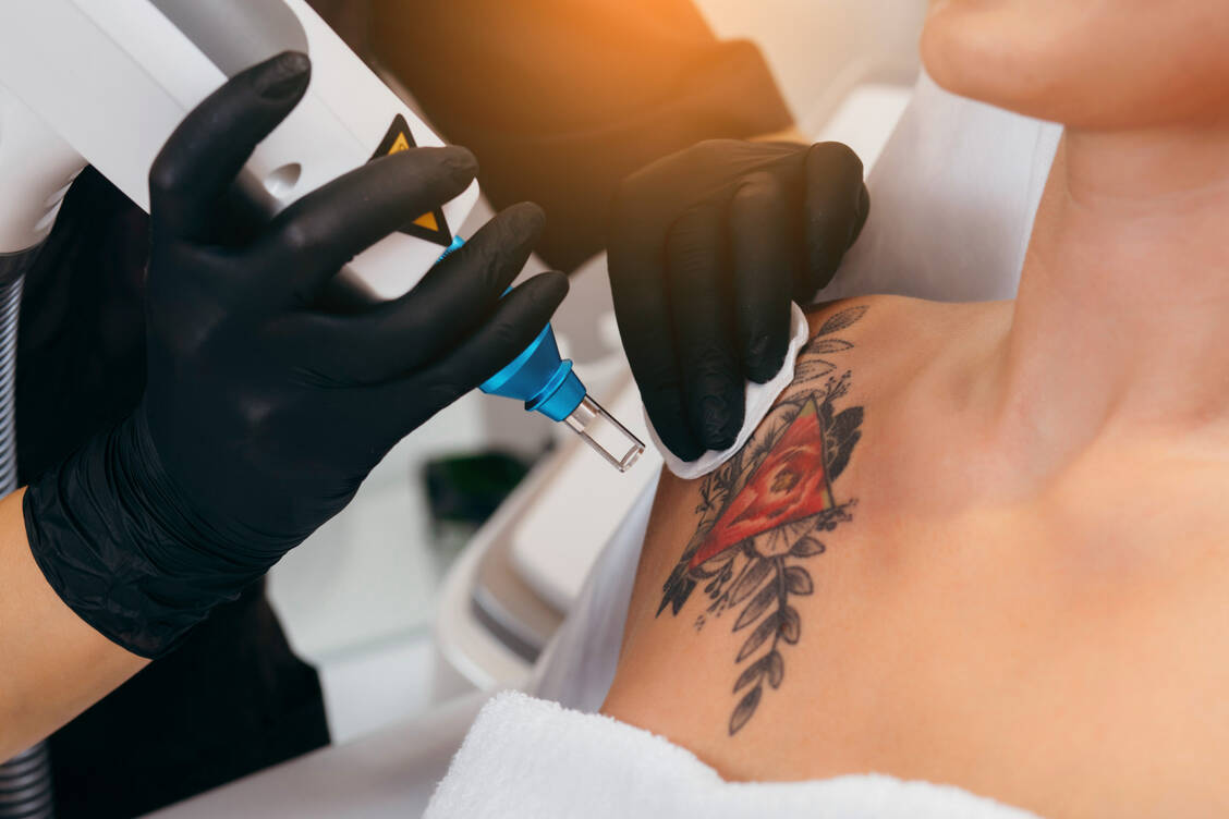 Seit 2021 dürfen nur noch approbierte Ärzte mit entsprechender Sachkunde ein Tattoo mit dem Laser entfernen. / Foto: Adobe Stock/andrew_shots