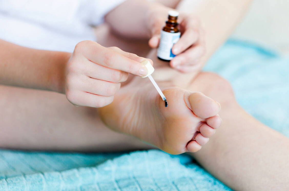 Salicylsäure sollte nicht ohne Hautschutz der umgebenden Haut mit Vaseline oder Zinkpaste aufgetragen werden. / Foto: Your Photo Today