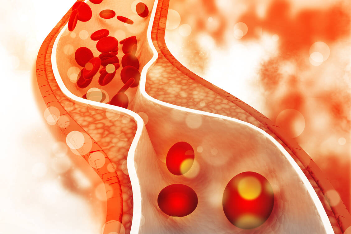 Stau im Blutfluss: Erhöhte Blutfettwerte können zu atherosklerotischen Gefäßauflagerungen führen und die Arterien verengen. / Foto: Adobe Stock/hywards