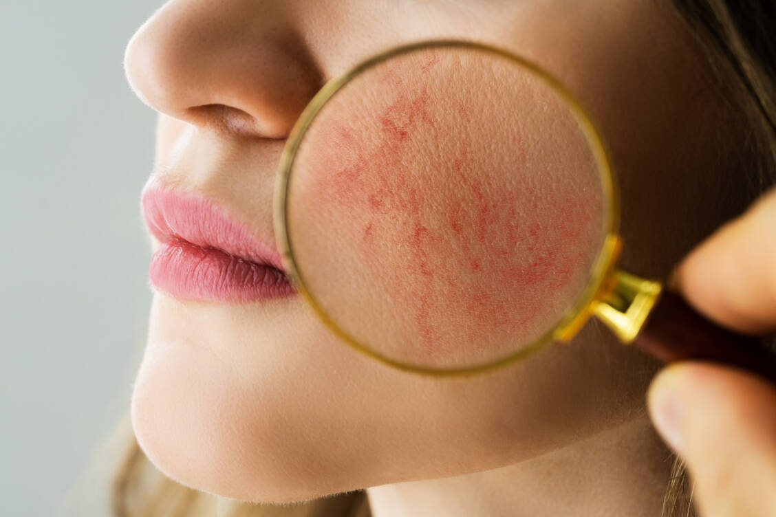 Die Diagnose Rosacea sollte man nicht in Eigenregie stellen, sondern stets beim Hautarzt abklären lassen. / Foto: Getty Images/Andrey Popov
