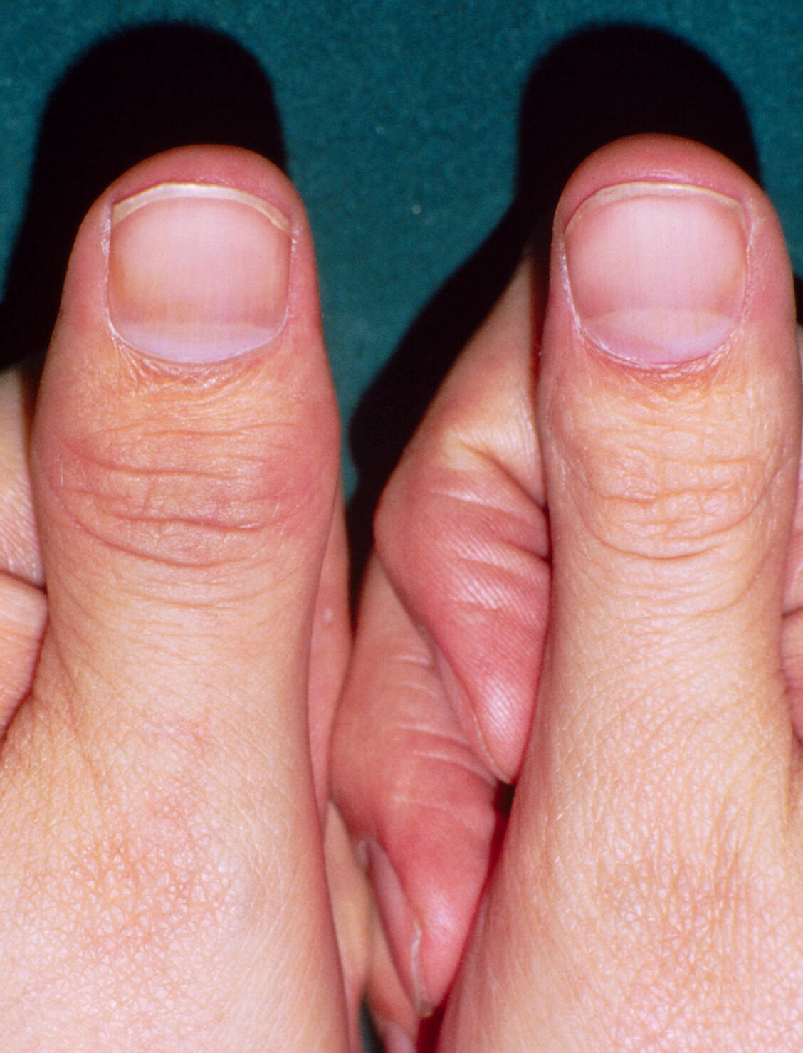 Bei der Psoriasis-Arthritis schwellen meist die Gelenke eines Fingers an. / Foto: Your Photo Today