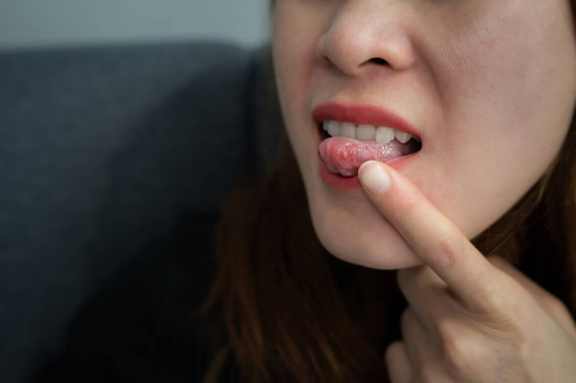 Ob an der Zunge, an der Innenseite von Wange oder Lippe oder am Gaumen: Aphten können ganz schön schmerzhaft sein.  / © Getty Images/	Boy_Anupong
