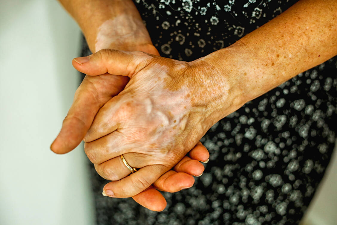 Auch nicht-endokrine Autoimmunerkrankungen wie Vitiligo können mit einem APS einhergehen. / Foto: Getty Images/MarijaRadovic