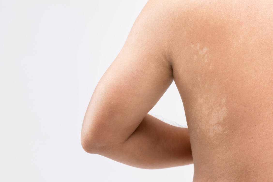 Die Pilzinfektion Pityriasis versicolor betrifft die äußere Hautschicht; sie ruft verfärbte schuppige Flecken hervor. / Foto: Adobe Stock/SKT Studio