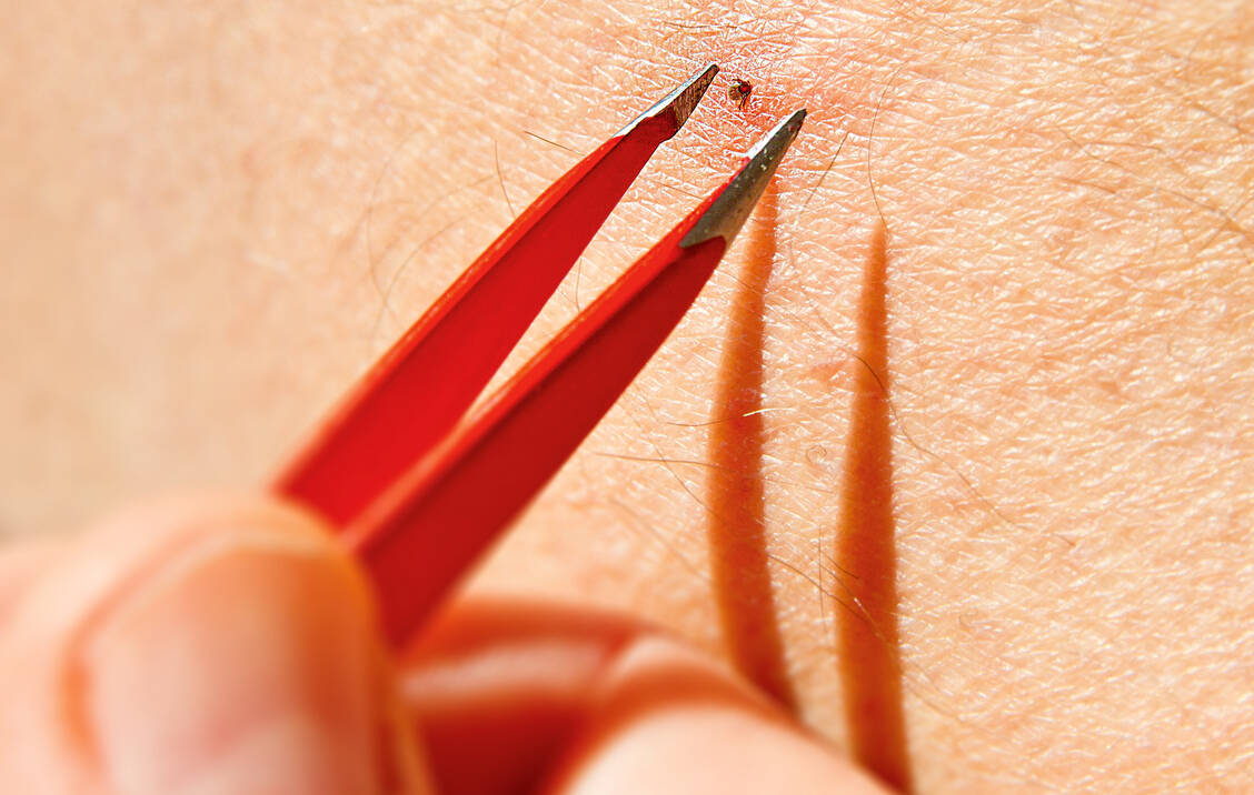 Ist kein spezielles Zeckenentfernungs-Werkzeug zur Hand, tut es es auch eine handelsübliche Pinzette aus der Nagel-Set. / Foto: Shutterstock/Juergen Faelchle