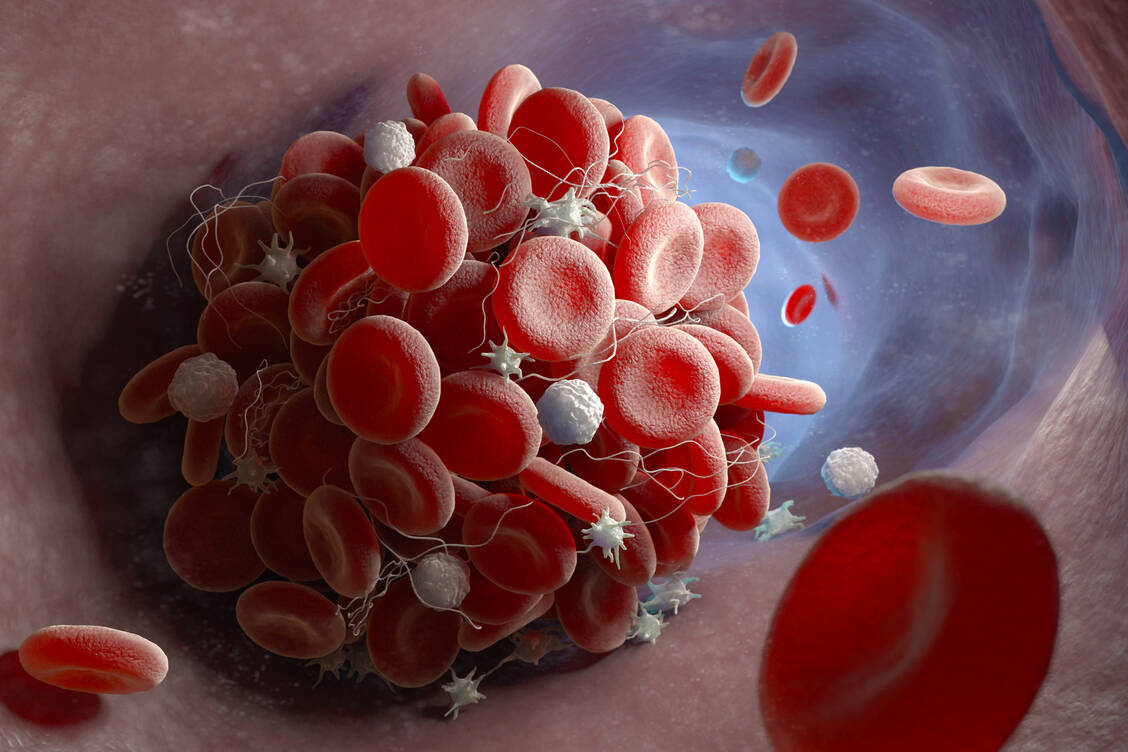 Thrombosen sind vor allem in den tiefen Beinvenen gefährlich, die das Blut zur Lunge transportieren. / Foto: Stock Adobe/Tatiana Shepeleva
