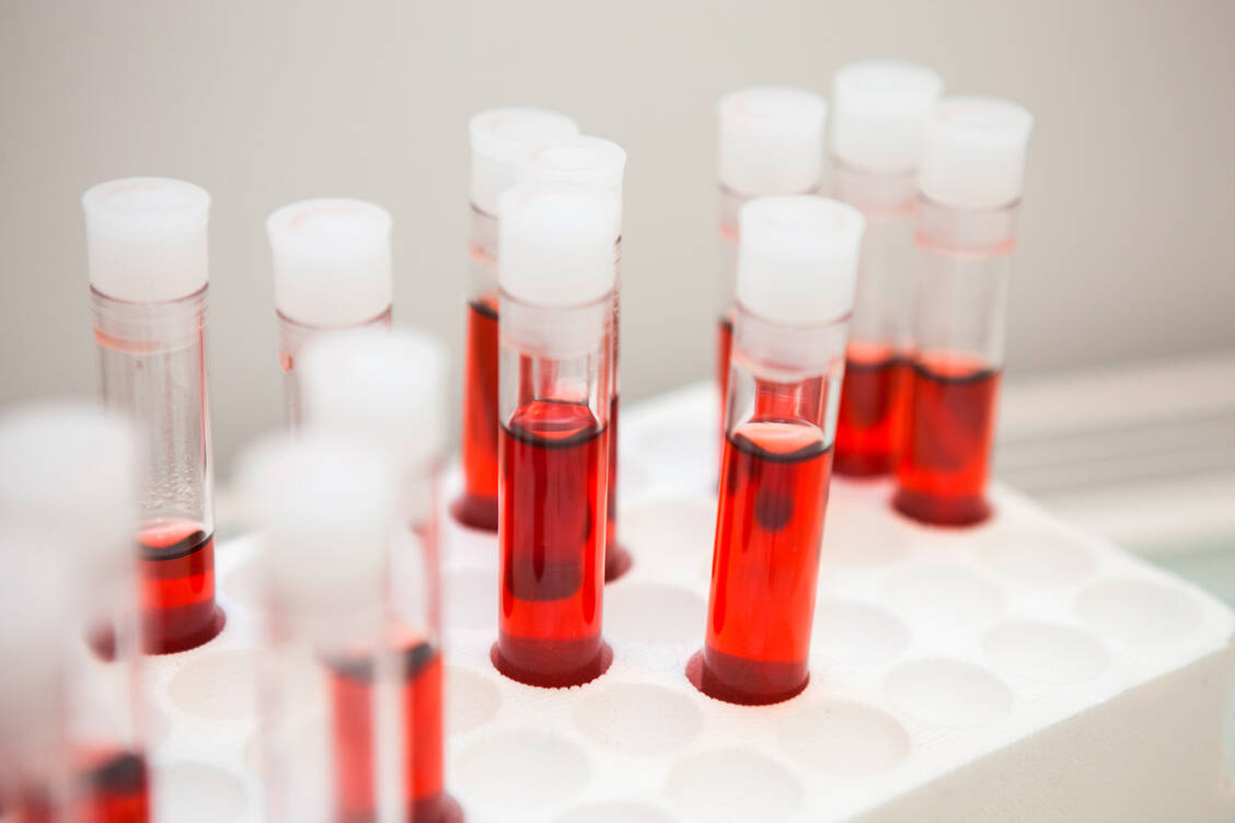 Aus Blut lassen sich Informationen über pathologisch veränderte Gewebe gewinnen, die bislang nur mit Biopsien zugänglich waren. Vor allem in der Krebsmedizin werden große Hoffnungen in die Liquid Biopsy gesetzt. / Foto: Adobe Stock/ChristianSchwier.