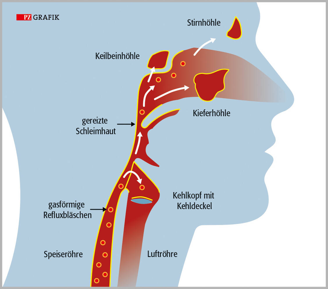 Kleine gasförmige Refluxbläschen beinhalten Magensäure sowie Pepsin und verursachen oberhalb der Speiseröhre Entzündungen und damit einen stillen Reflux. / © PZ Grafik/Jens Ripperger