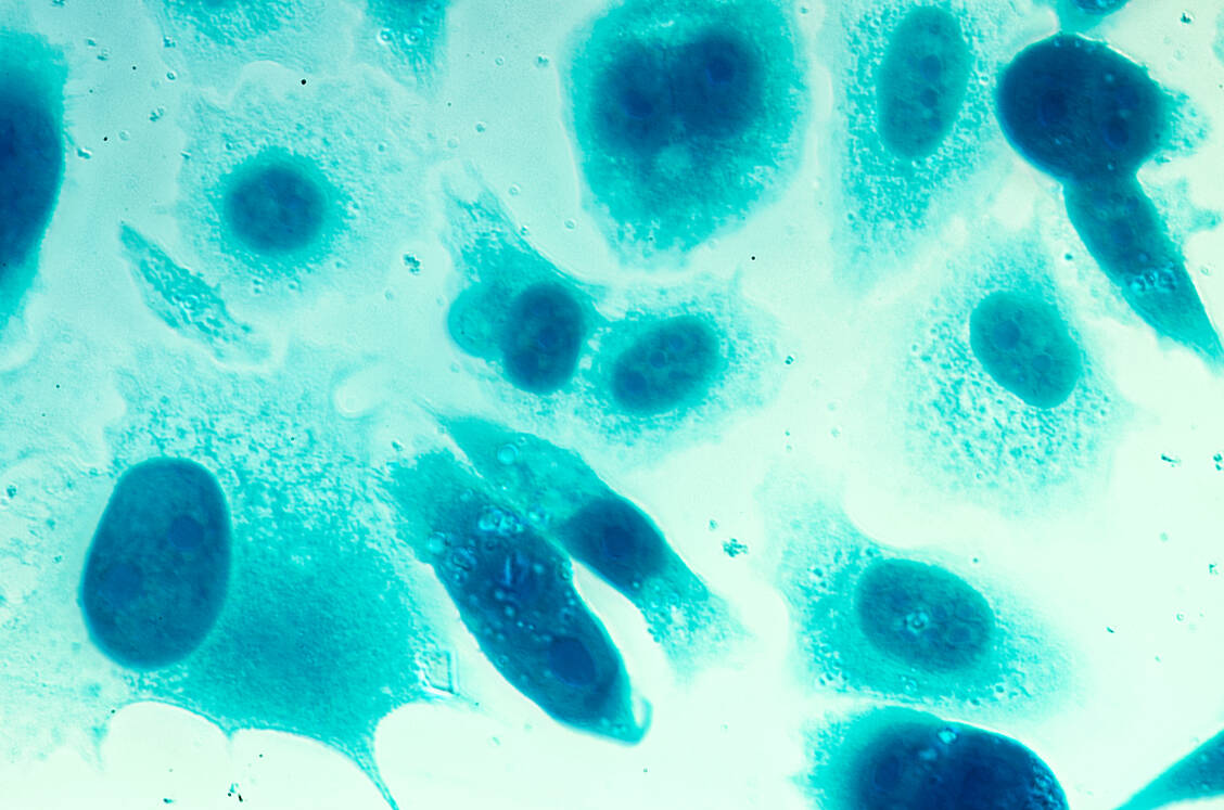 Prostatakrebs kann tödlich enden — daher ist eine frühe Diagnose der Krankheit wichtig. / Foto: Shutterstock/Heiti Paves