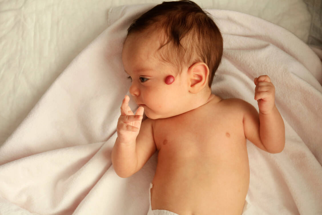 Kleine Blutschwämme bilden sich in der Regel von alleine zurück. Bei großen, sogenannten segmentalen Hämangiomen ist der Einsatz von Propranolol aber ebenso notwendig wie sinnvoll. / © Getty Images/Tolgart