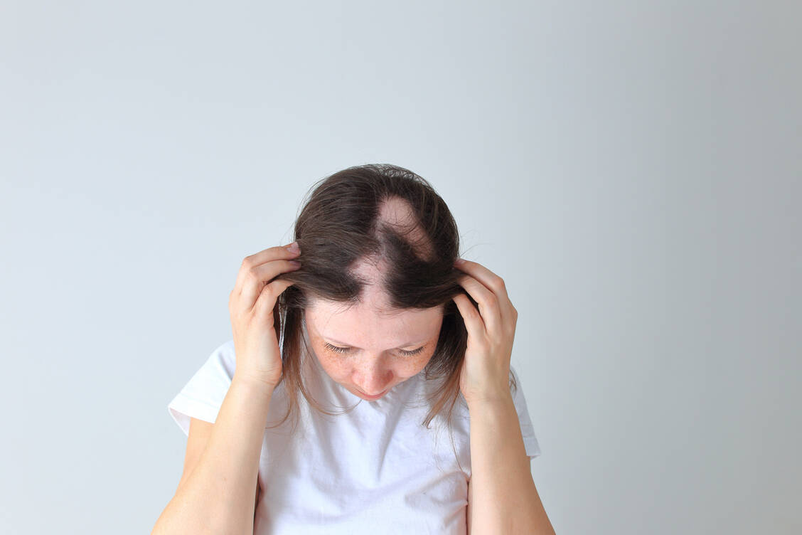Die Alopecia areata beginnt meist mit einer kreisrunden Stelle am Kopf, wobei auch andere Körperbereiche betroffen sein können. / Foto: Adobe Stock/Nadya Kolobova