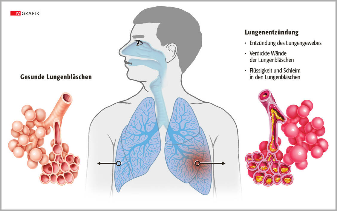 Gasaustausch findet in den Millionen von Lungenbläschen (Alveolen) sowie in den sie umgebenden Kapillaren statt. Bei einer Pneumonie ist diese Funktion in vielen Fällen stark eingeschränkt. Betroffene bekommen zu wenig Sauerstoff. / Foto: Grafik: Stephan Spitzer
