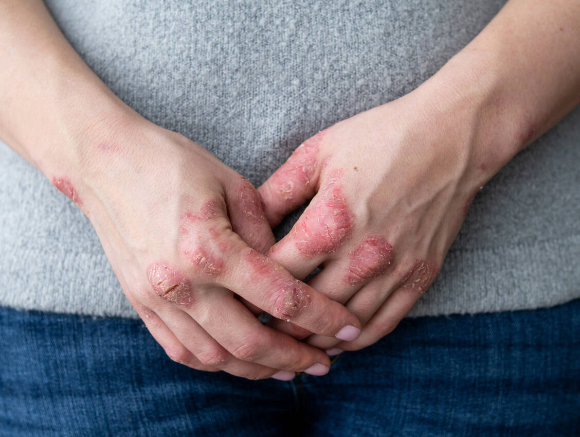 Je nach Schweregrad der Erkrankung muss die Therapie der Schuppenflechte während einer Schwangerschaft angepasst werden. / Foto: Adobe Stock/IIIRusya
