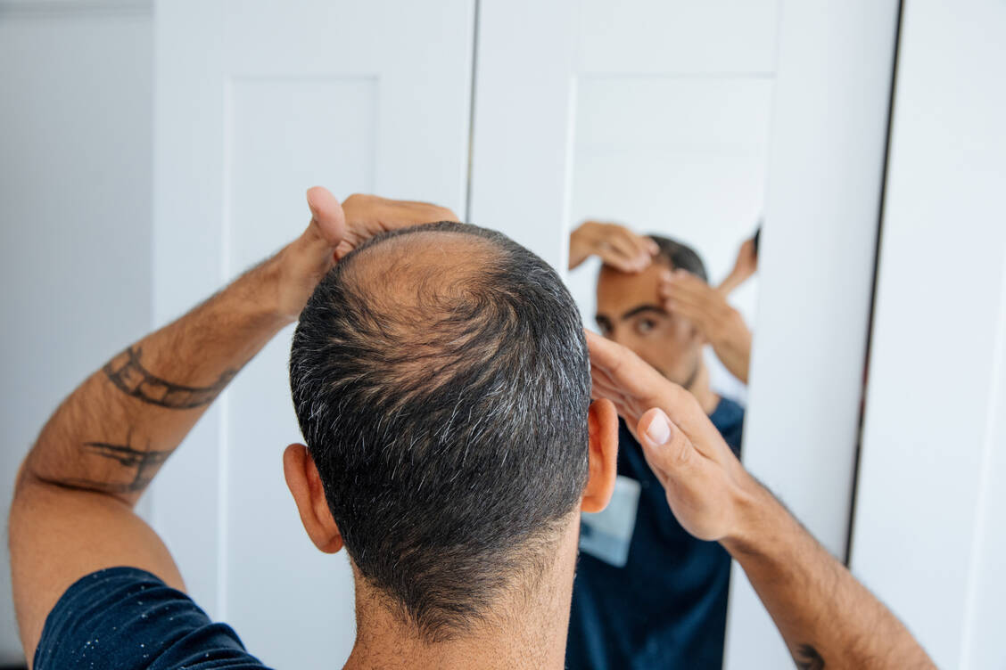 Haarausfall kann belastend sein. / Foto: Getty Images/agrobacter