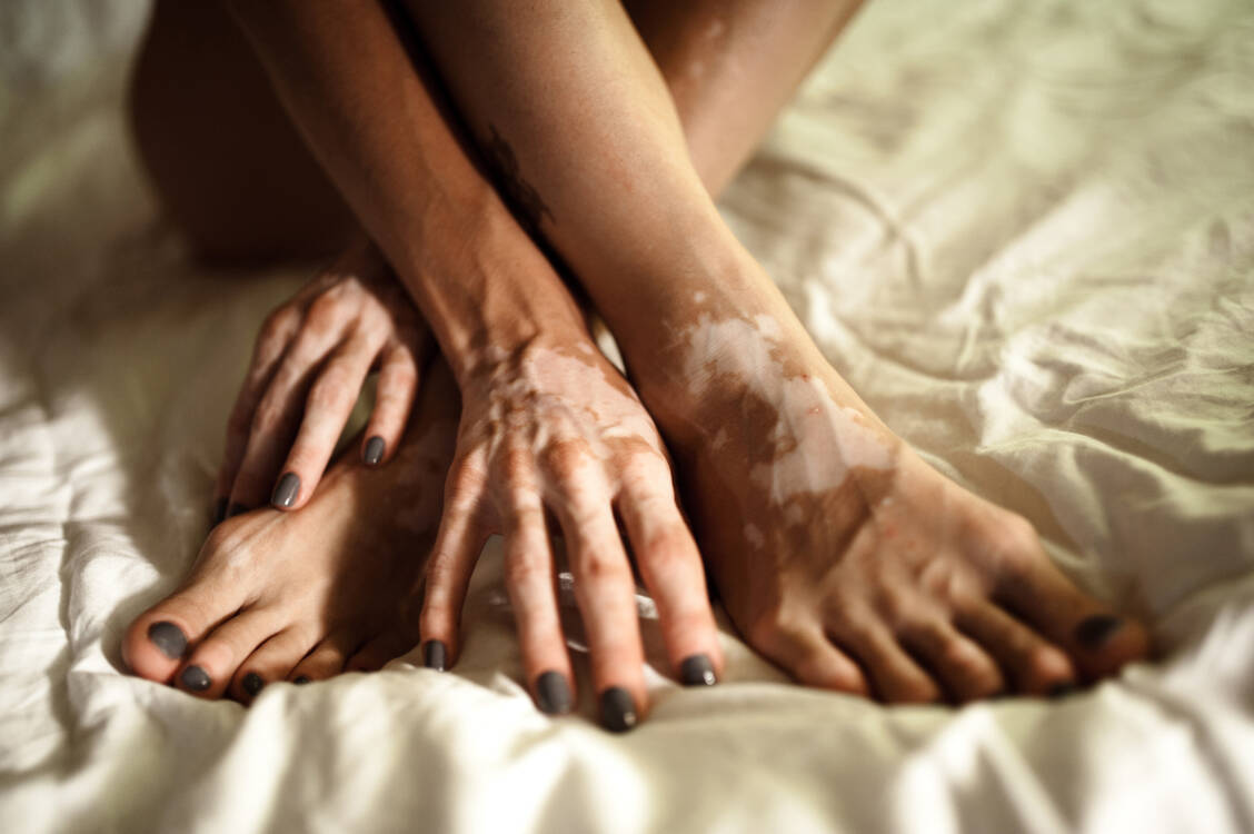 Die nicht segmentale Vitiligo ist die häufigste Form der Vitiligo. / © Getty Images/Natalie Zotova