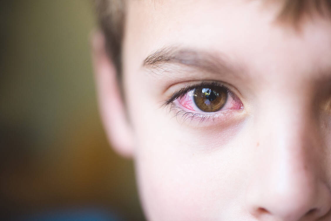 Rote Augen, Brennen, Jucken: Dahinter können unter anderem Bakterien, Viren oder eine Allergie stecken.  / Foto: Getty Images/Teresa Short