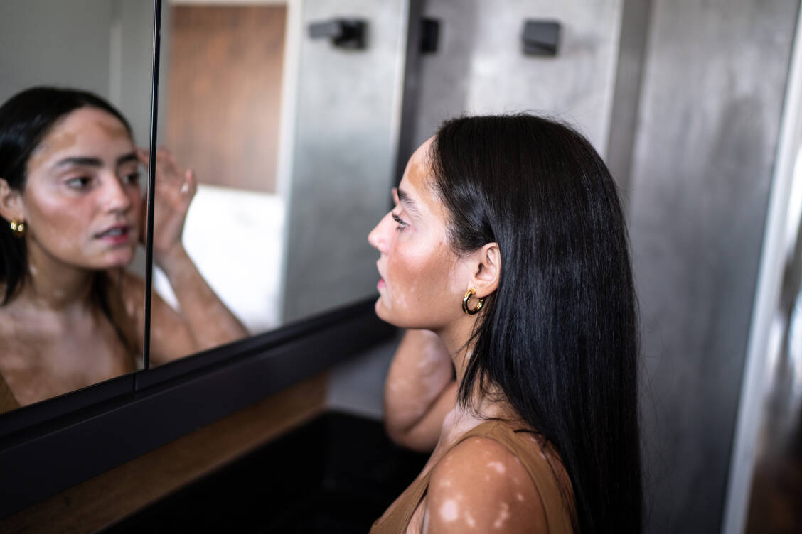 Vitiligo ist nicht ansteckend, dennoch werden Betroffene oft erschrocken angestarrt. / © Getty Images/FG Trade