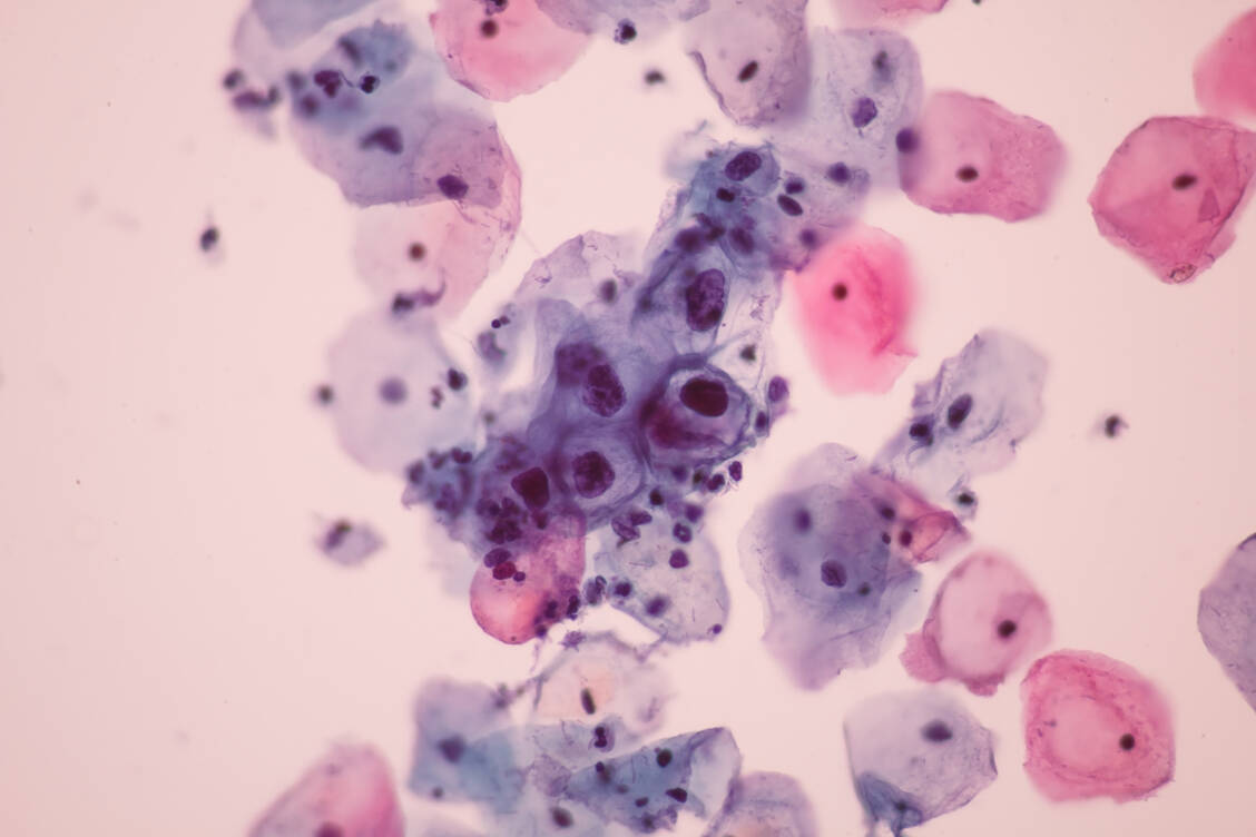 Unter dem Mikroskop fast hübsch anzuschauen: humane Papillomaviren auf Zervixepithelzellen. / Foto: Shutterstock/E. Druzhinina