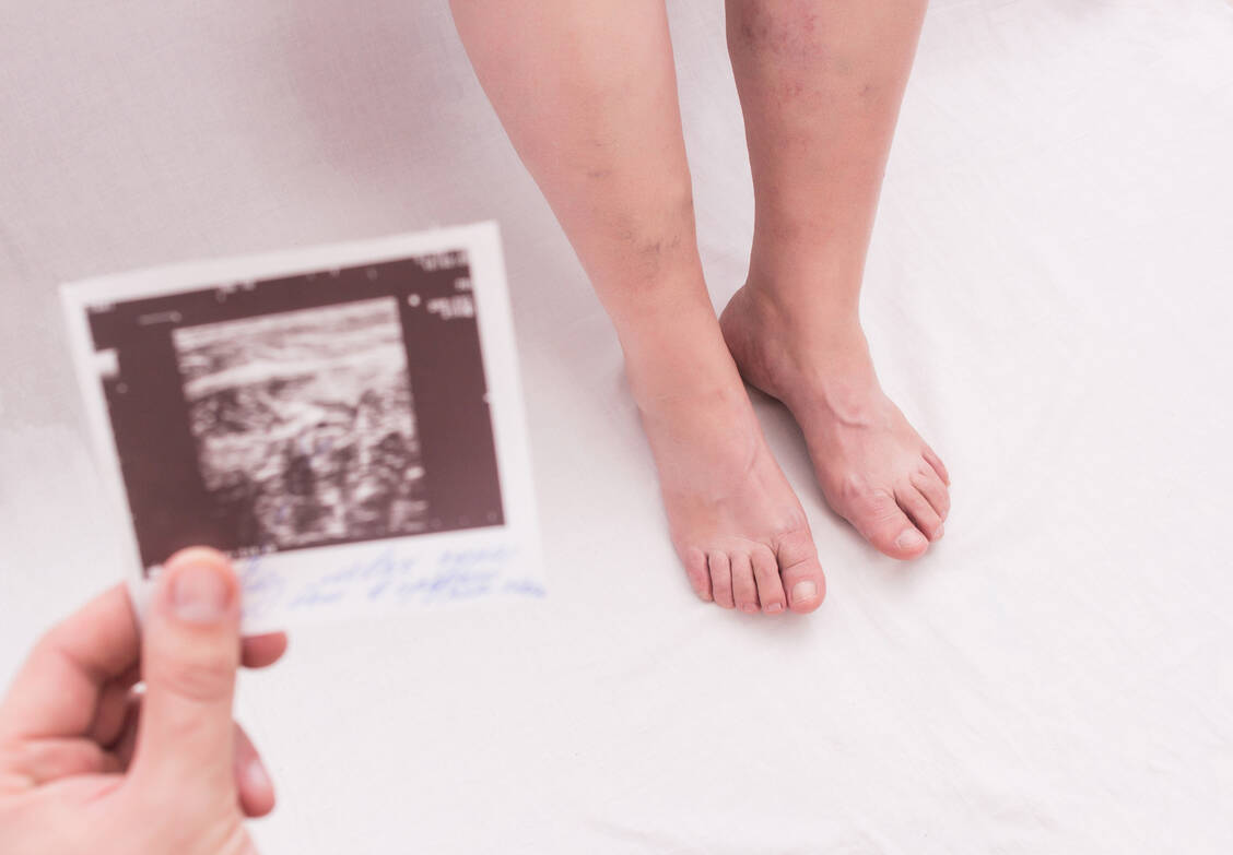 Wer die typischen Thrombose-Symptome bei sich feststellt, sollte unmittelbar ein Arzt aufsuchen. / Foto: Adobe Stock/Henadzy
