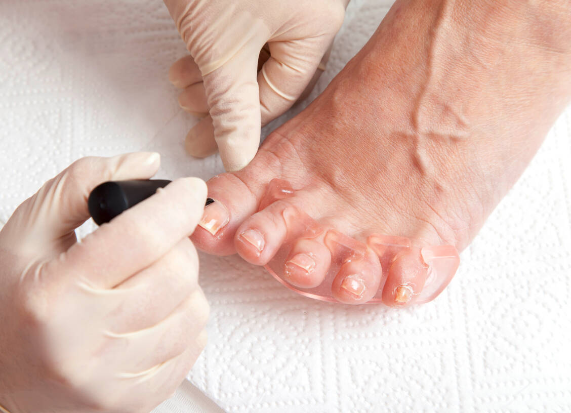 Speziell Diabetiker sollten ihre Fußnägel nur von Fachleuten pflegen und behandeln lassen. / Foto: Adobe Stock/perfectmatch