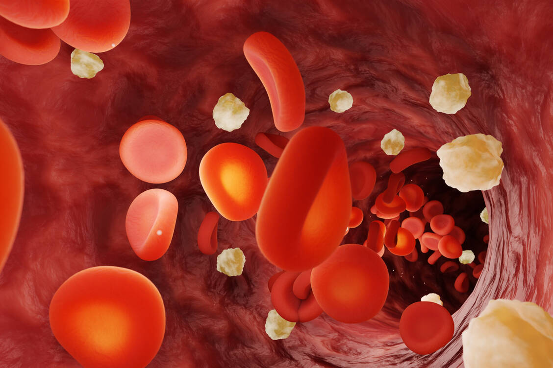 Erhöhte Blutfette wie LDL-Cholesterin tragen zur Plaquebildung in Gefäßen bei und erhöhen das Risiko für Herzinfarkt und Schlaganfall. / © Getty Images/	Dragon Claws