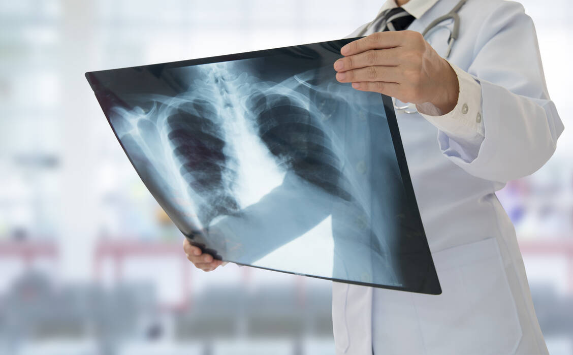 Anhand einer Röntgenaufnahmen lässt sich eine Covid-19-Infektion gut diagnostizieren. / Foto: Shutterstock/create jobs 51
