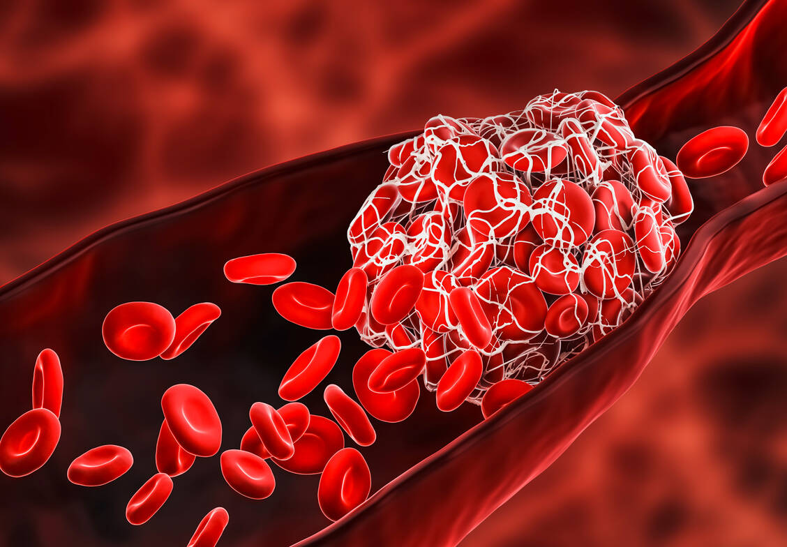 Die Embolie ist eine lebensbedrohliche Komplikation einer Thrombose. / Foto: Getty Images/libre de droit