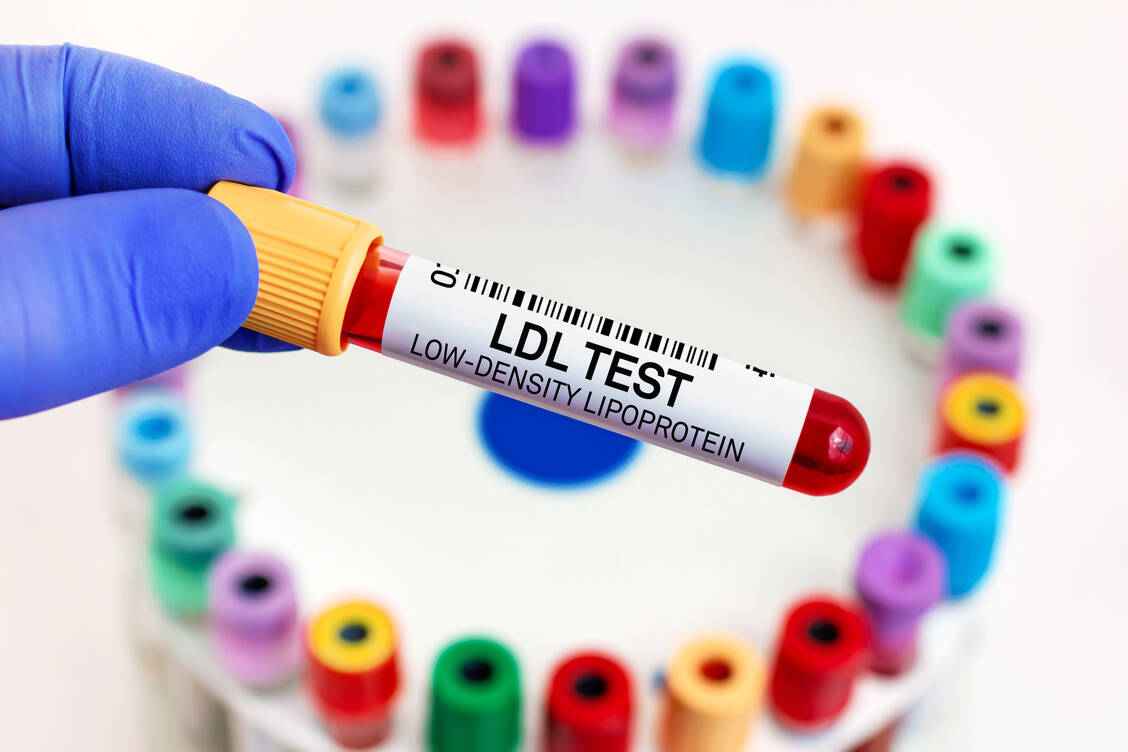 Im Alter senken Statine den Cholesterolspiegel stärker als in jungen Jahren.  / Foto: Adobe Stock/angellodeco